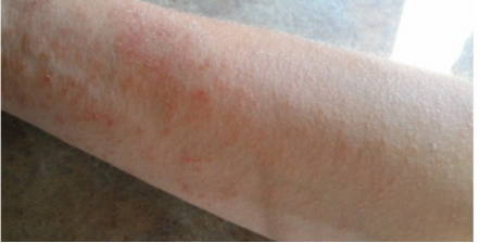Do you know, yeast overgrowth can cause this Itchy rash?
